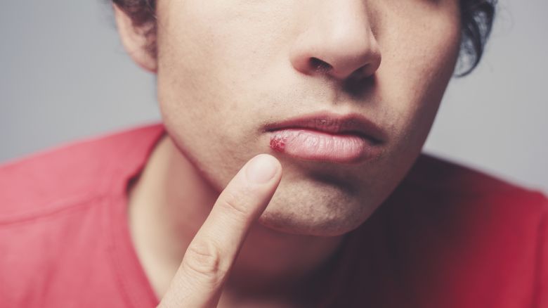 Herpes Cause E Soluzioni