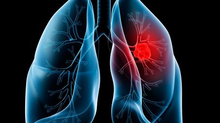 Tumore al polmone, la campagna L’esame più importante della tua vita