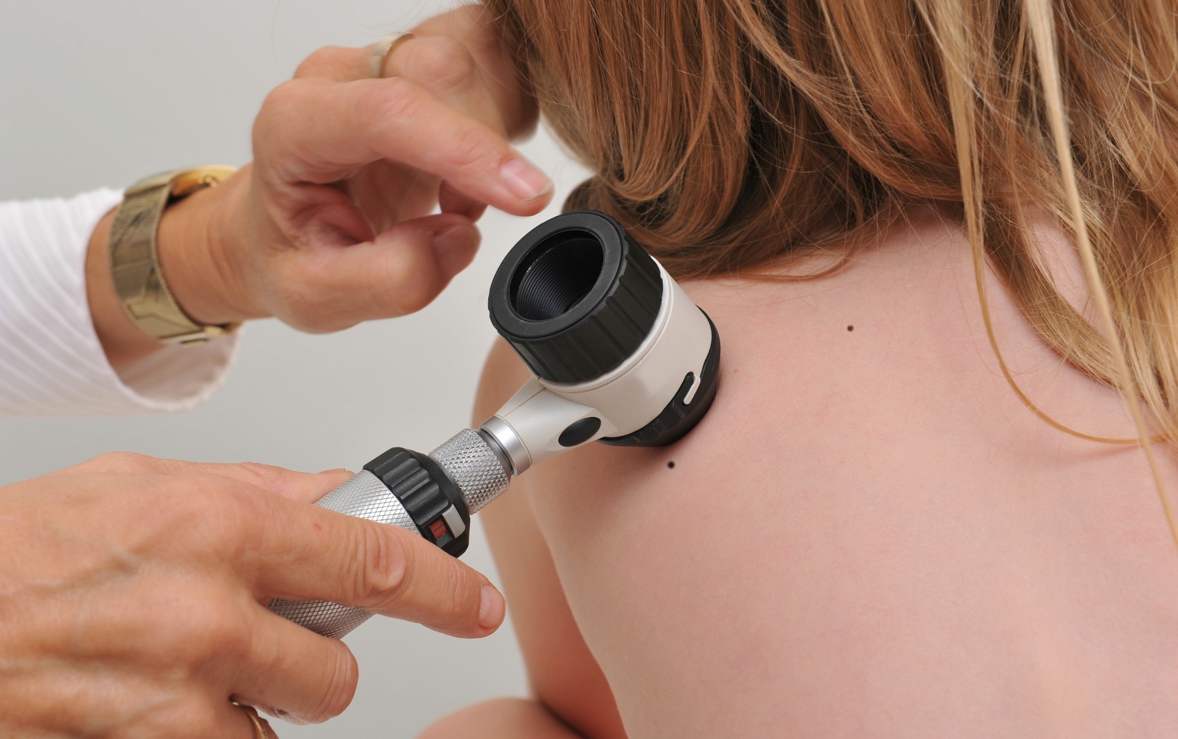 Melanoma: le nuove terapie Melanoma: le nuove terapie