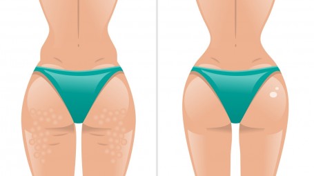 Quali sono i rimedi contro la cellulite?