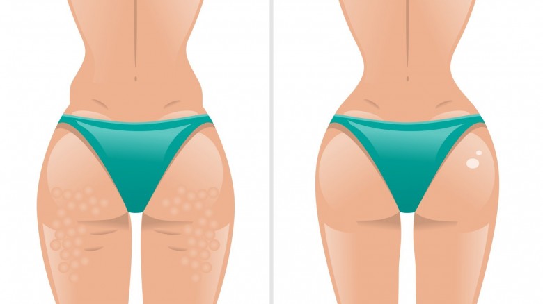 cellulite sclerotizzata