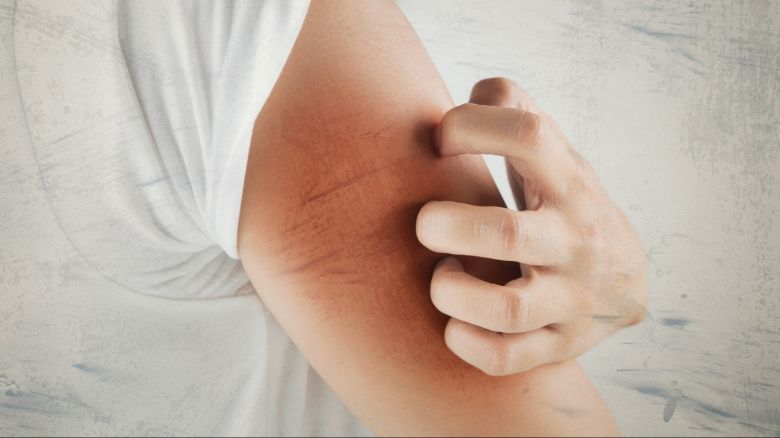 come perdere peso durante lassunzione di cortisone