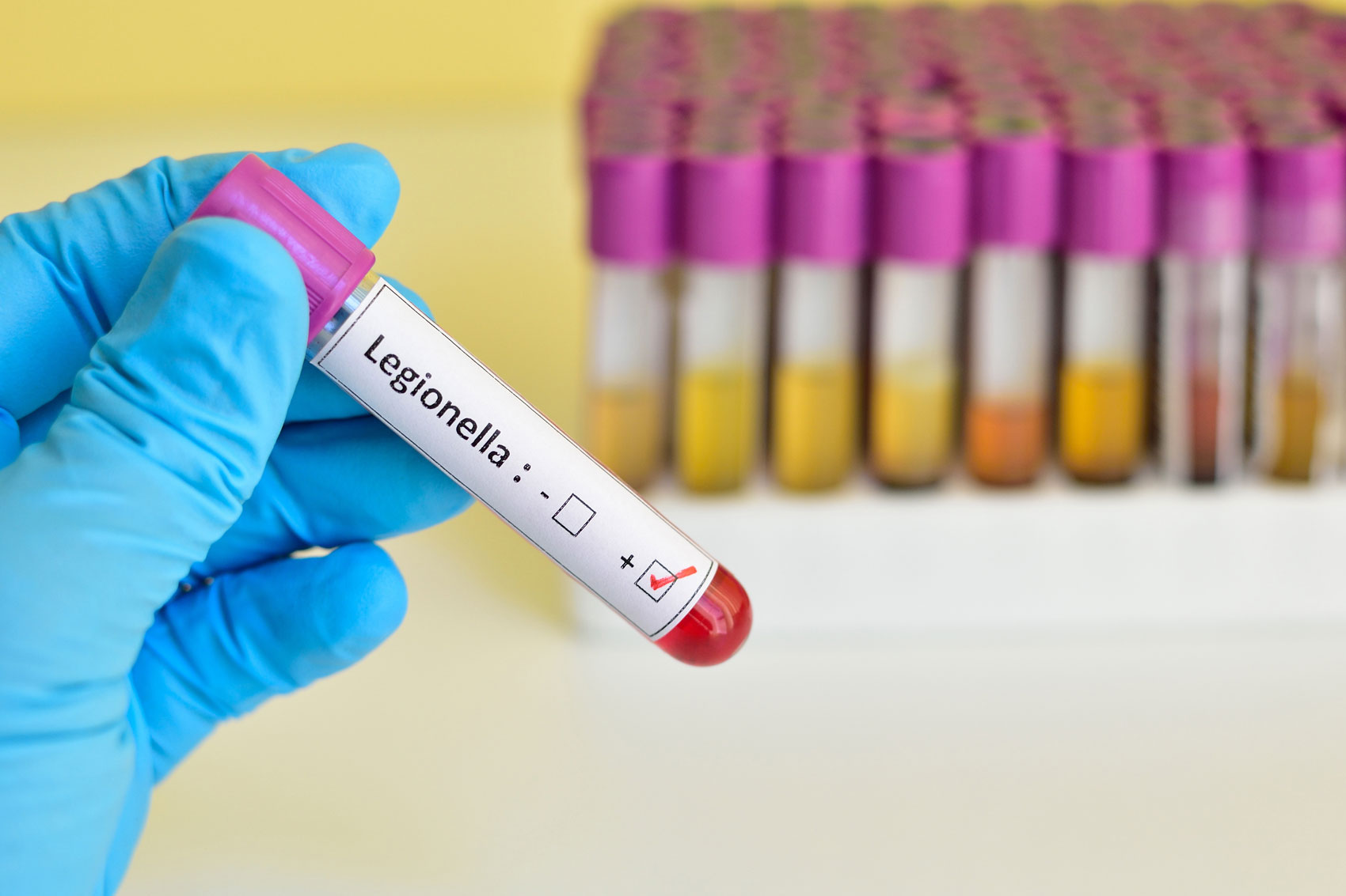 Legionella: sintomi e cure