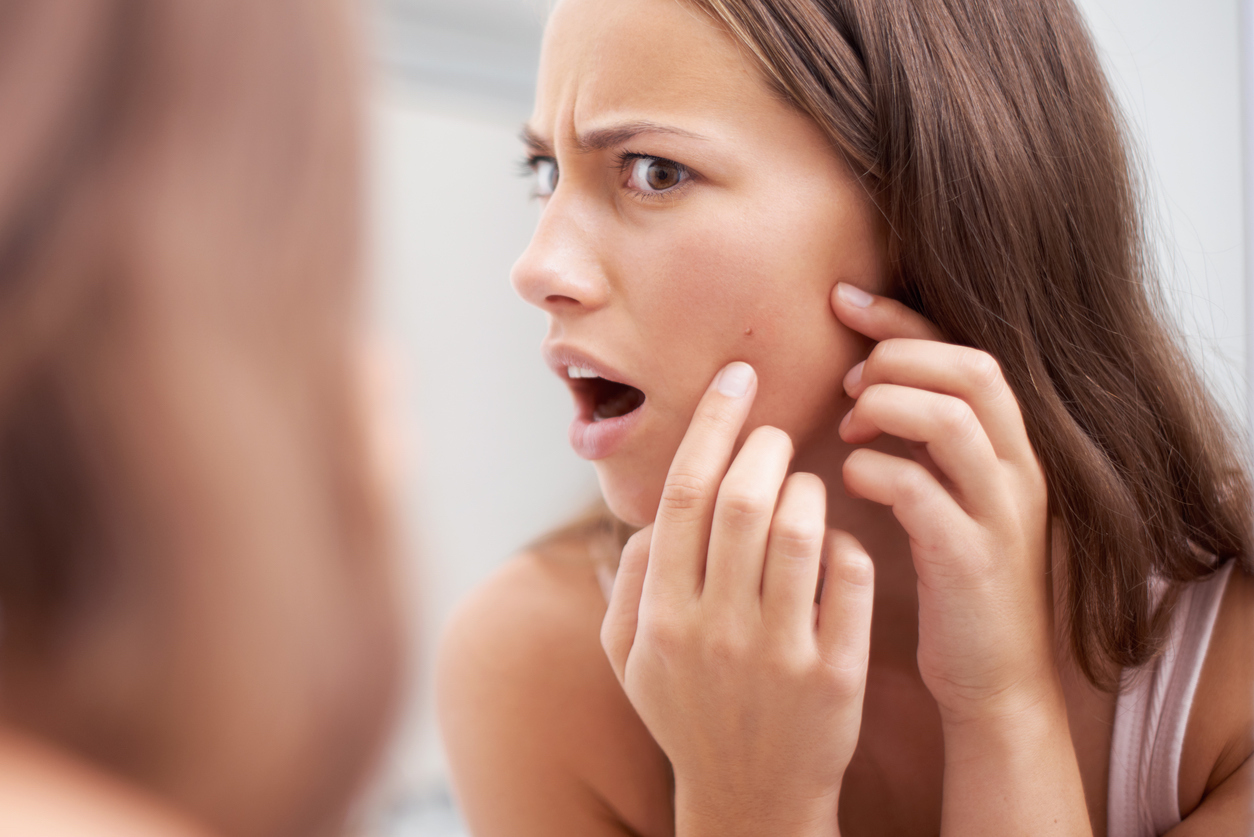Acne da stress: 4 rimedi naturali Acne da stress: 4 rimedi naturali