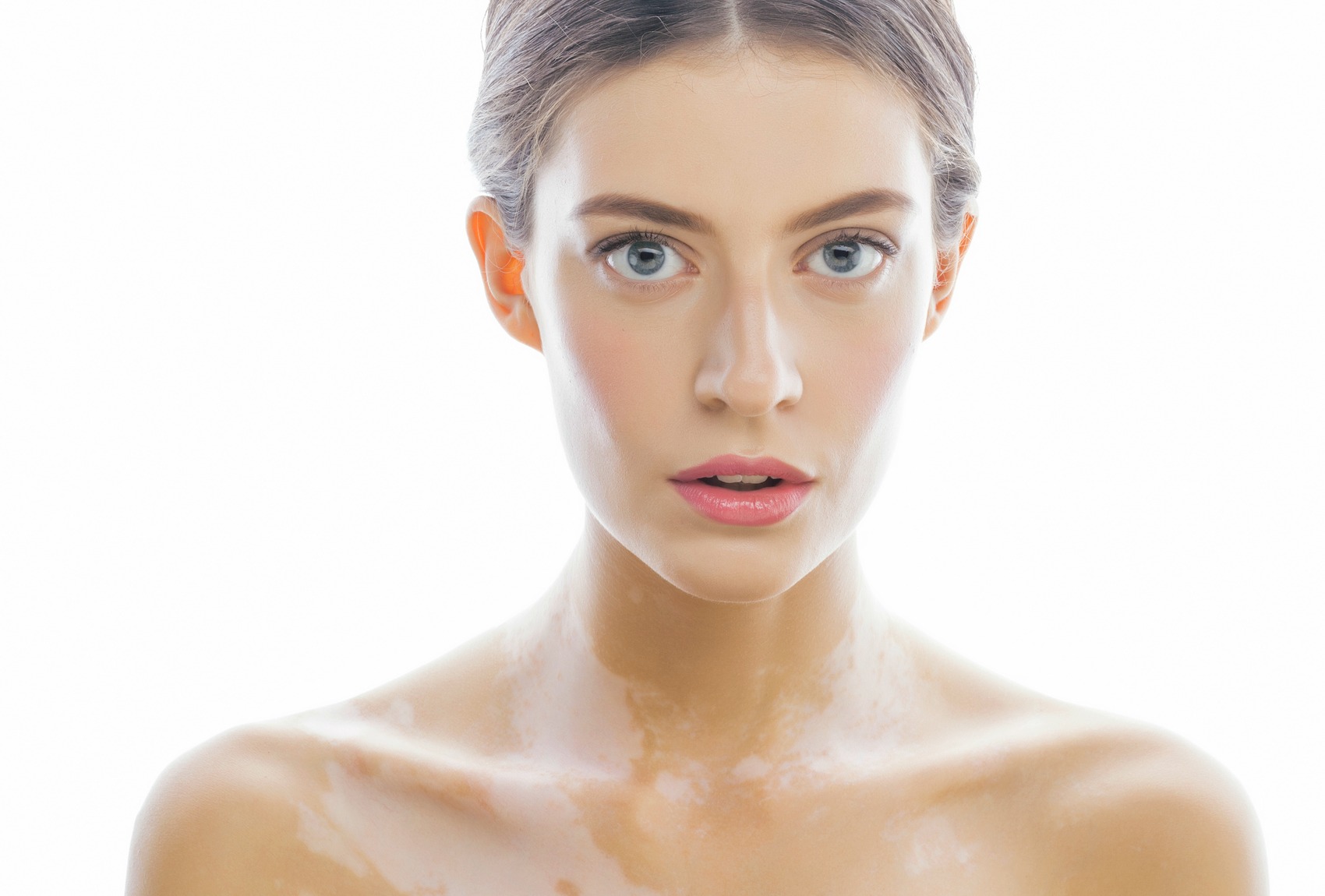 Raggi di luce fredda contro psoriasi e vitiligine