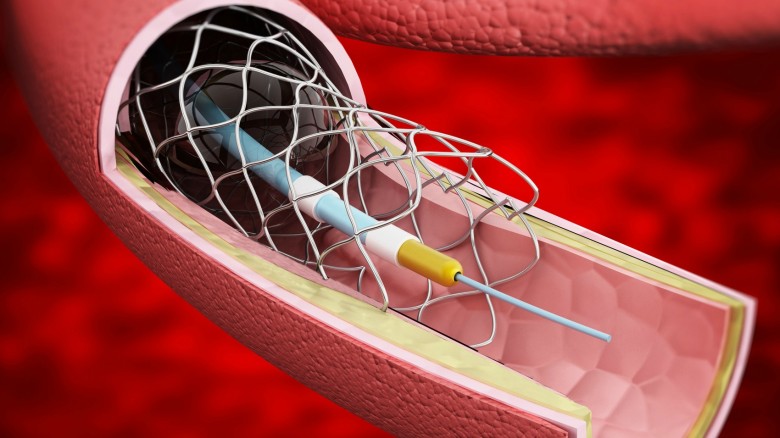 Arterie chiuse: la nuova soluzione