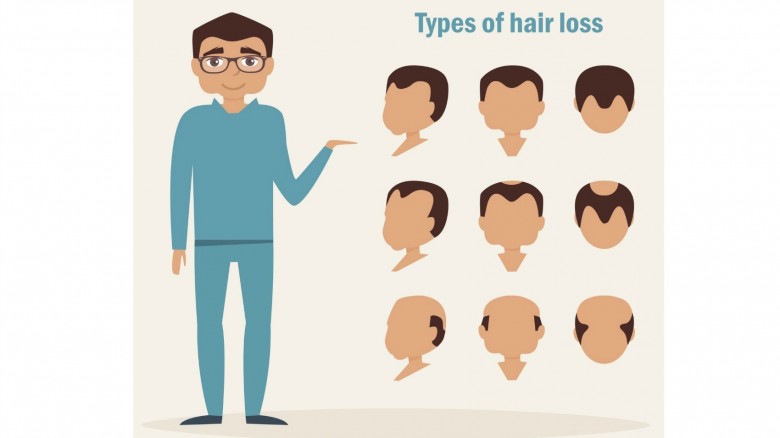 Alopecia rimedi antichi