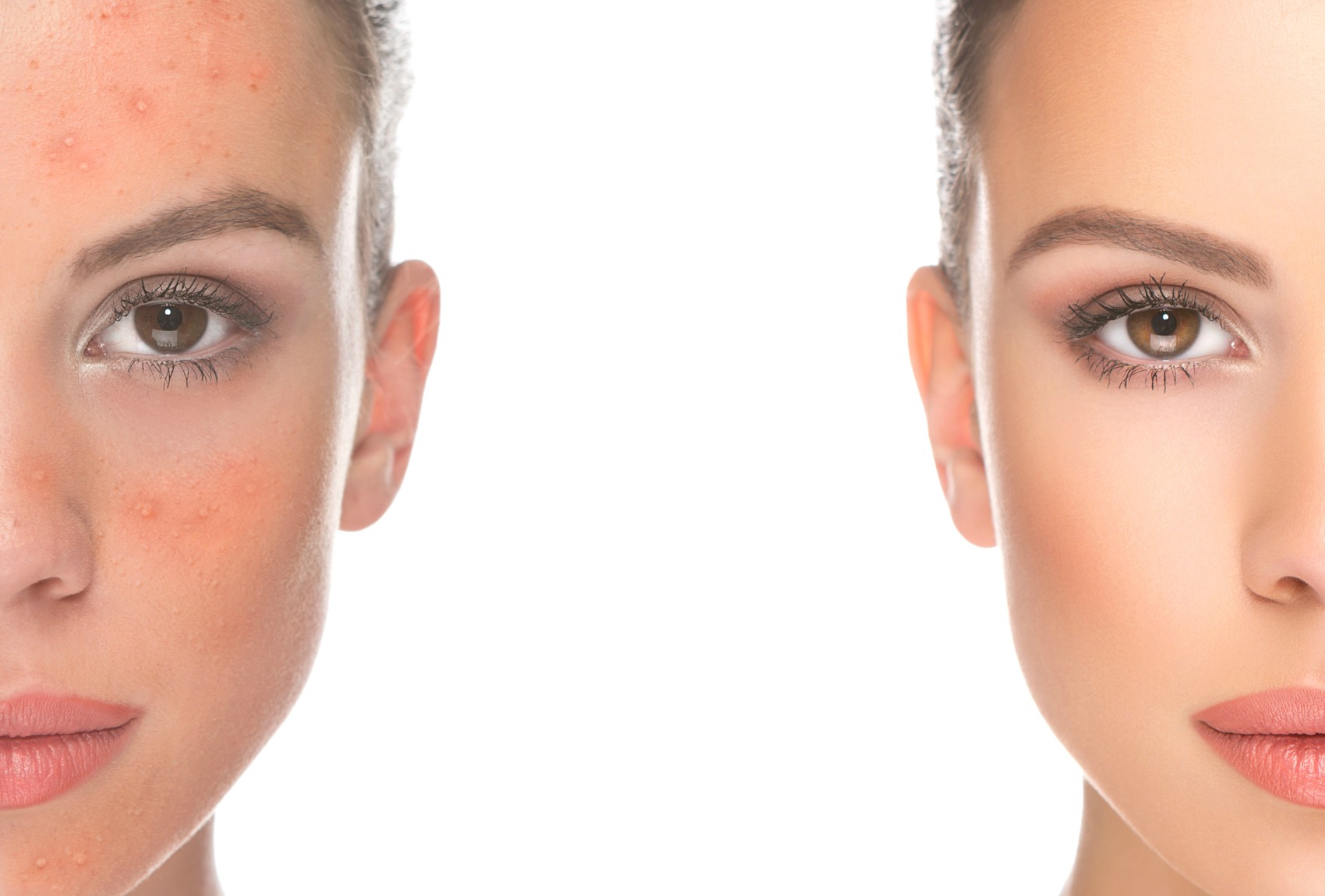 Acne: i benefici della luce blu