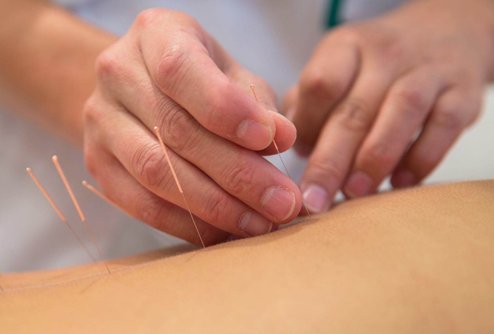 Agopuntura: 4 motivi per sceglierla