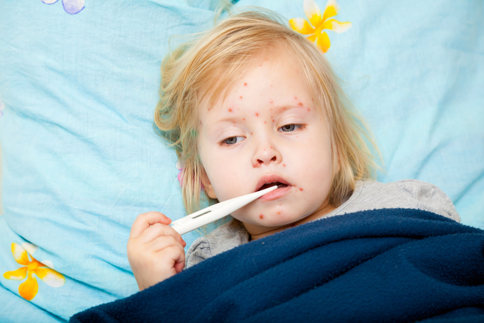 Il morbillo, Prof. Pregliasco Il morbillo, Prof. Pregliasco