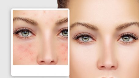 Couperose e rosacea: cosmetici, farmaci e trattamenti per combatterle