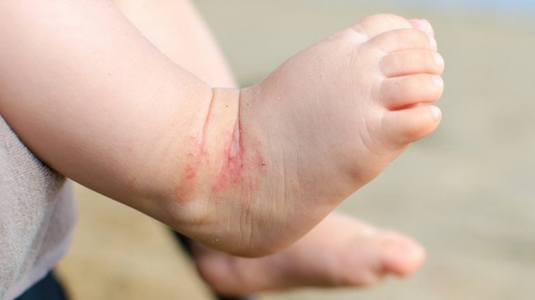 Dermatite atopica neonato, Dermatite 6 anni -