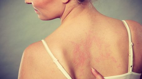 Dermatite da sudore: cause e sintomi
