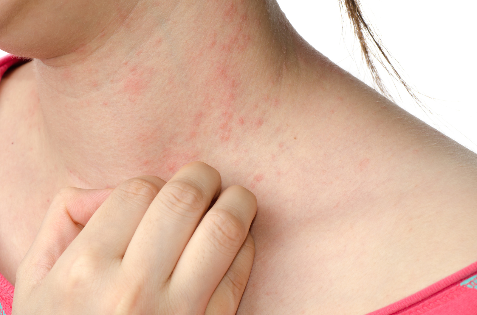 Dermatite: tipologie, cause e rimedi Dermatite: tipologie, cause e rimedi
