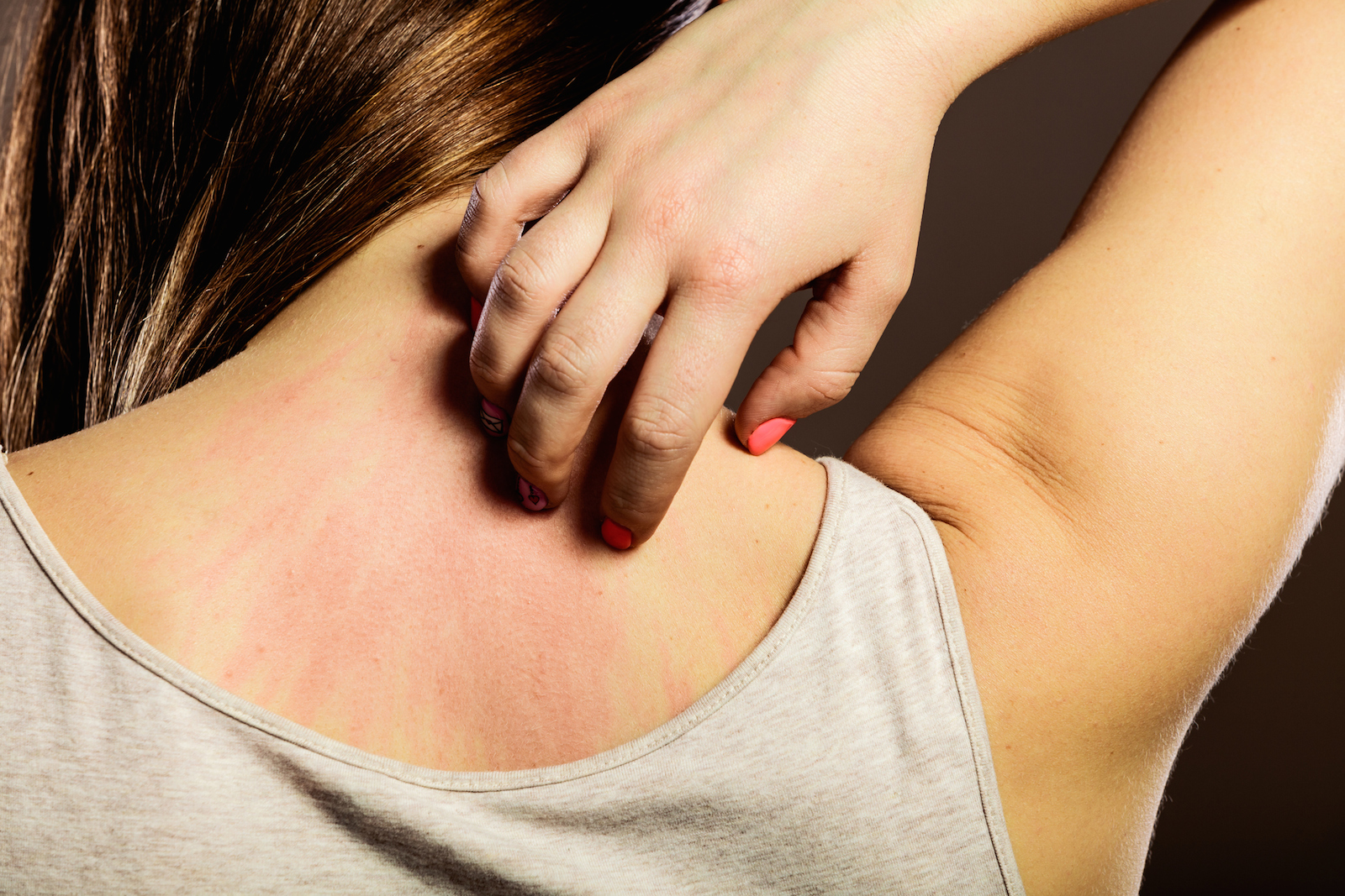 Dermatite Da Stress I Sintomi E Le Cure