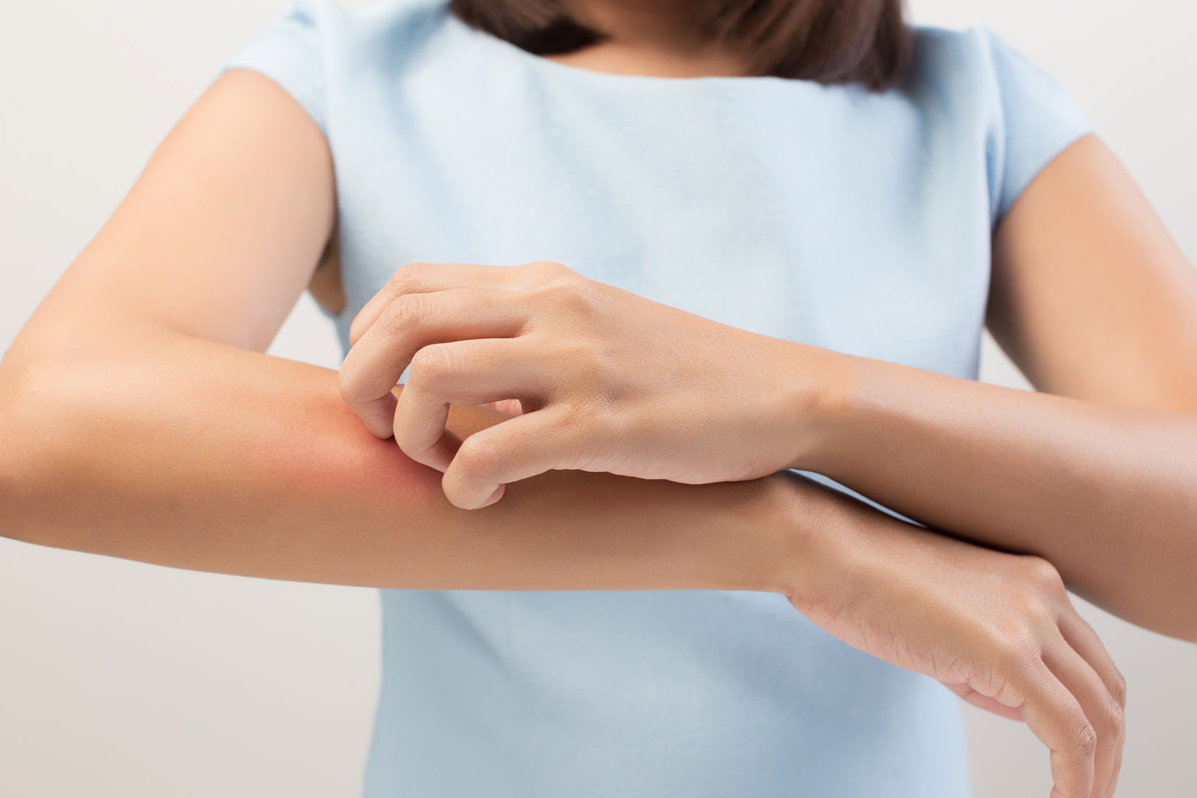 Psoriasi: i rimedi naturali per combatterla Psoriasi: i rimedi naturali per combatterla
