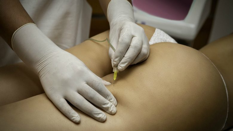 Galleria foto 'Cellulite: perché va affrontata ora (con i trattamenti mirati)' - foto 2