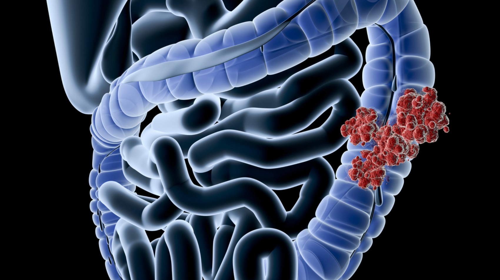 Tumore al colon: i sintomi e le cure per prevenire Tumore al colon: i sintomi e le cure per prevenire