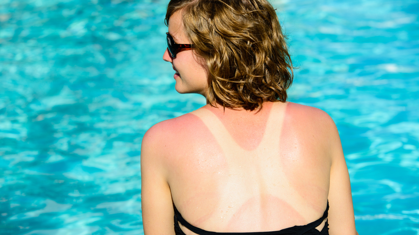 Eritema e scottature solari: come prevenirle e come rimediare Eritema e scottature solari: come prevenirle e come rimediare