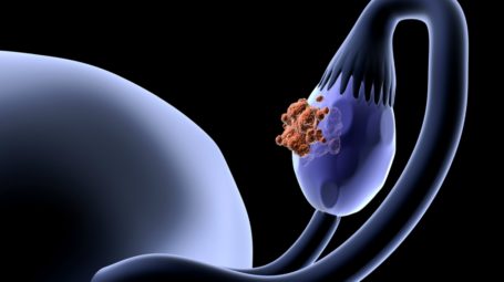 Tumore ovarico, da Acto il Libro bianco per conoscerlo e affrontarlo