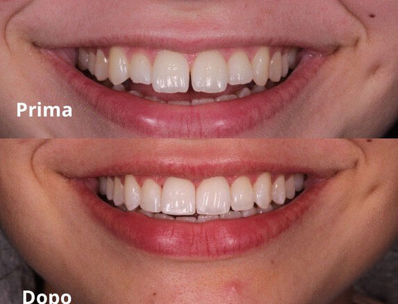 Galleria foto 'Michele Inzaghi e il bonding dentale: come trasformare il sorriso senza faccette' - foto 2