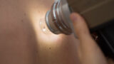 Melanoma in crescita per colpa dell’ozono