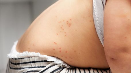 bambino, schiena, punti rosi, scarlattina, rosolia