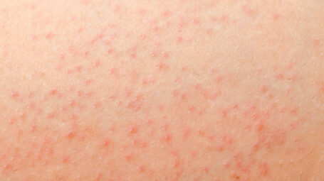 Folliculite, brufoli, pelle