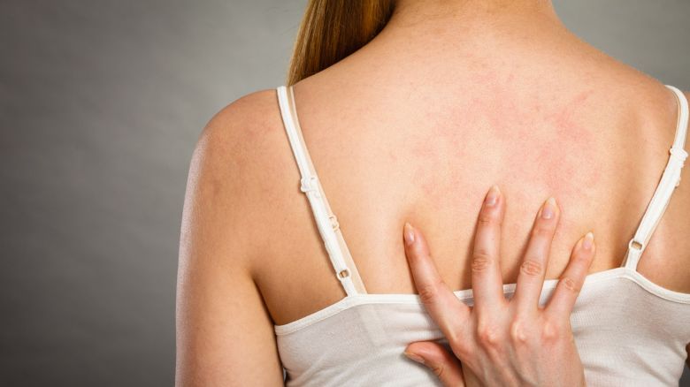 Quell’insospettabile intolleranza all’istamina: sintomi, cause, cure