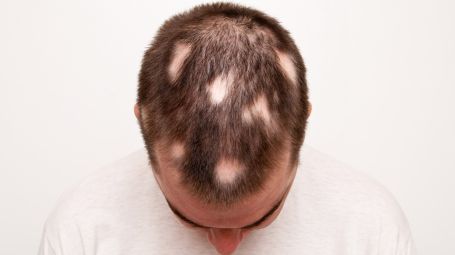 alopecia, capelli