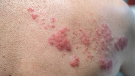 Herpes zoster, varicella, rash cutaneo, schiena, pelle