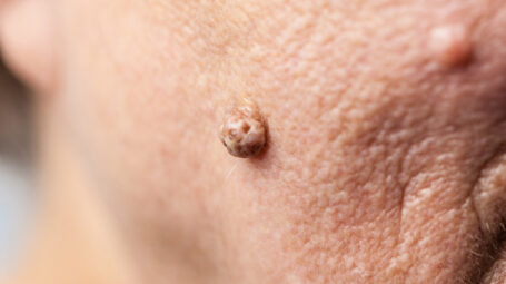 Fibromi penduli: cosa sono, le cause, le cure