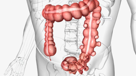 Diverticoli, intestino