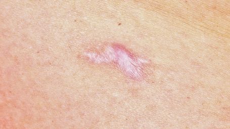 Cicatrici ipertrofiche: cosa sono, le cause, i rimedi