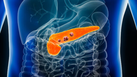 Pancreas o cancro del pancreas con organi e tumori o cellule cancerose