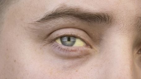 occhi gialli, ittero, sindrome di Gilbert