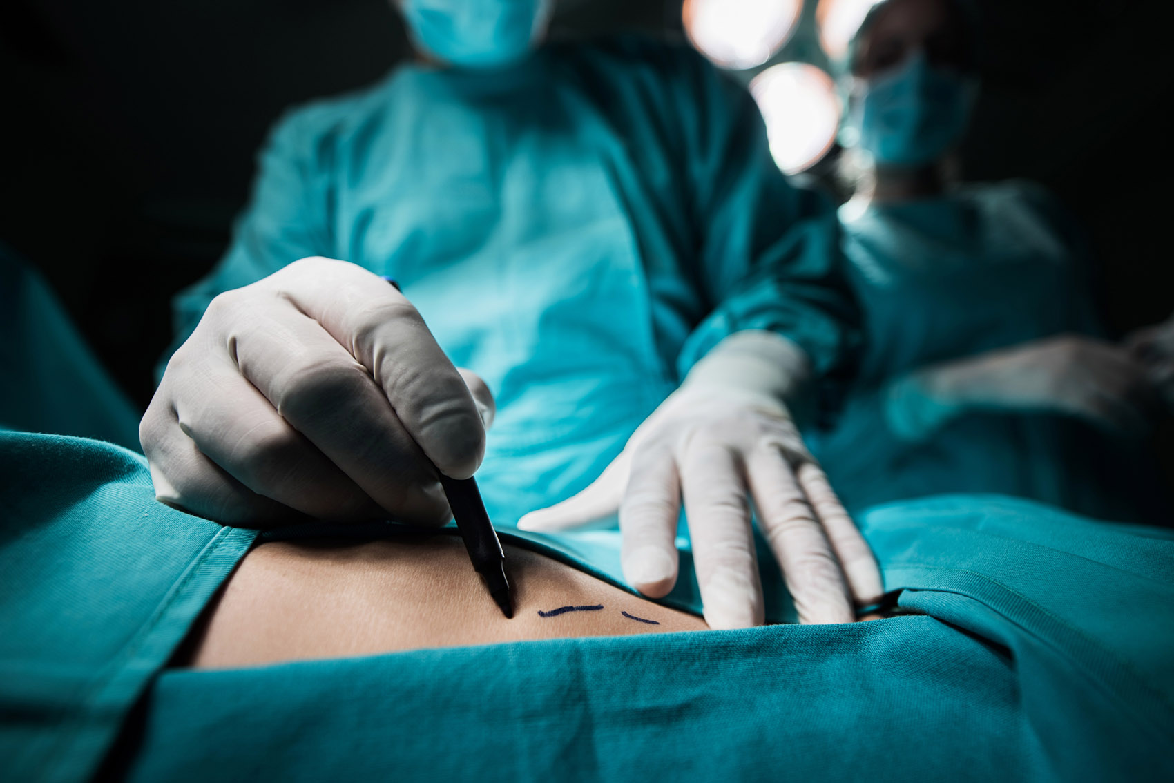 Liposuzione: quando farla e quando andare per vie legali Liposuzione: quando farla e quando andare per vie legali