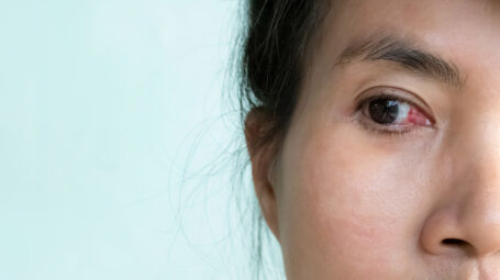 Pterigio, infiammazione occhio