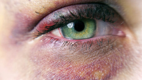 occhio nero, ematoma perioculare