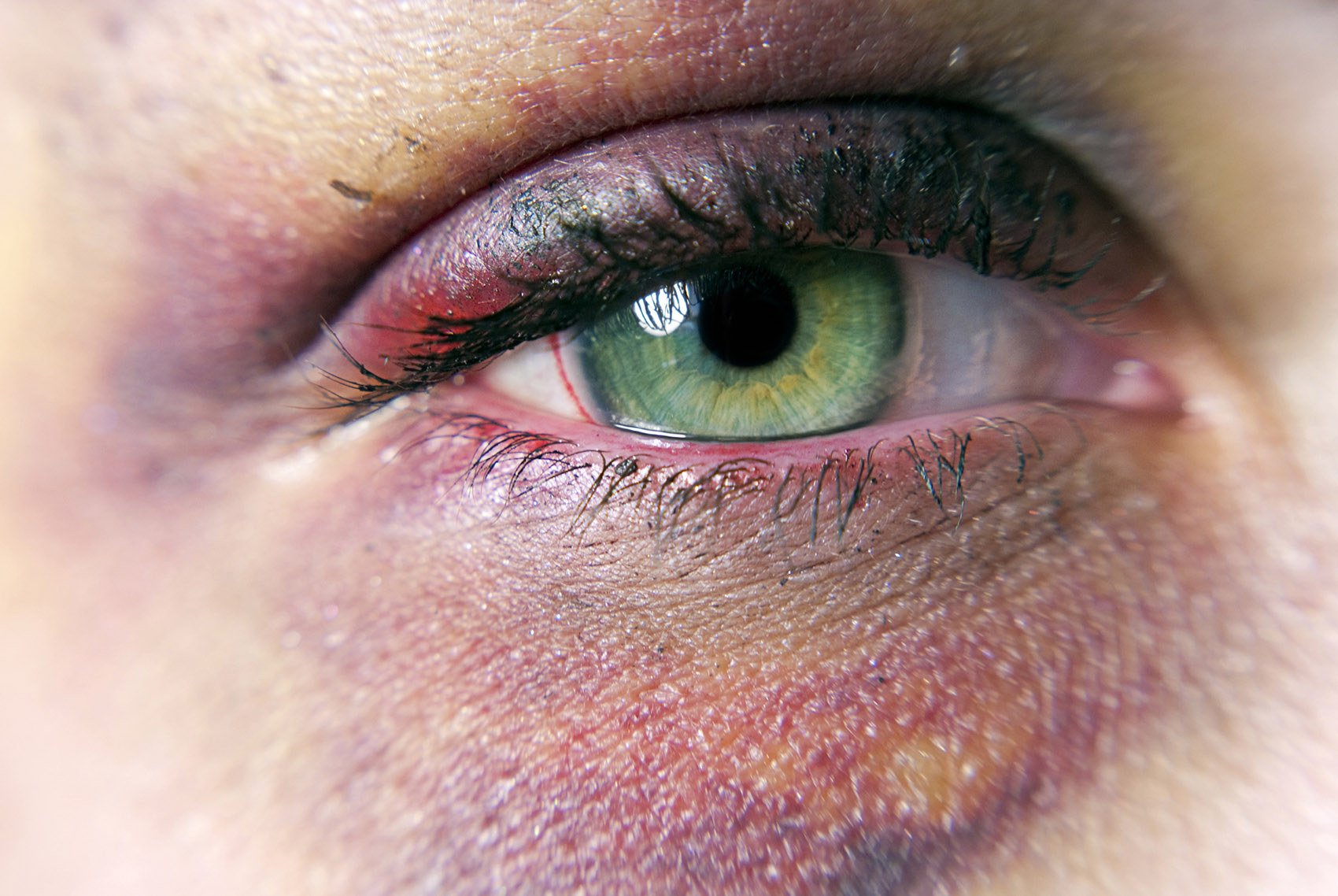 Occhio nero: che cos’è l’ematoma perioculare, cause, sintomi, rimedi