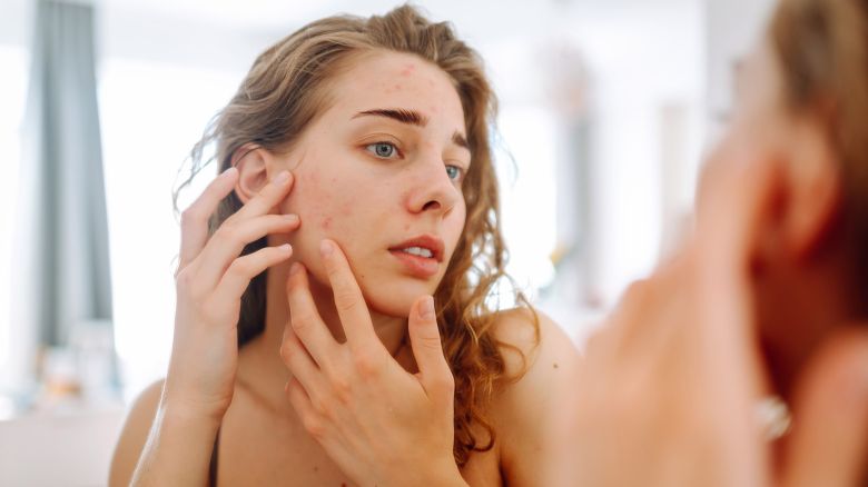 Acne: i 10 errori più comuni da evitare