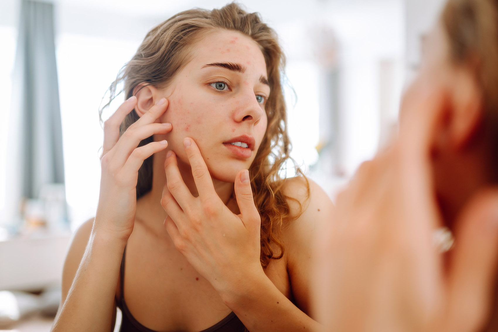 Come combattere l’acne shaming e rafforzare l’autostima