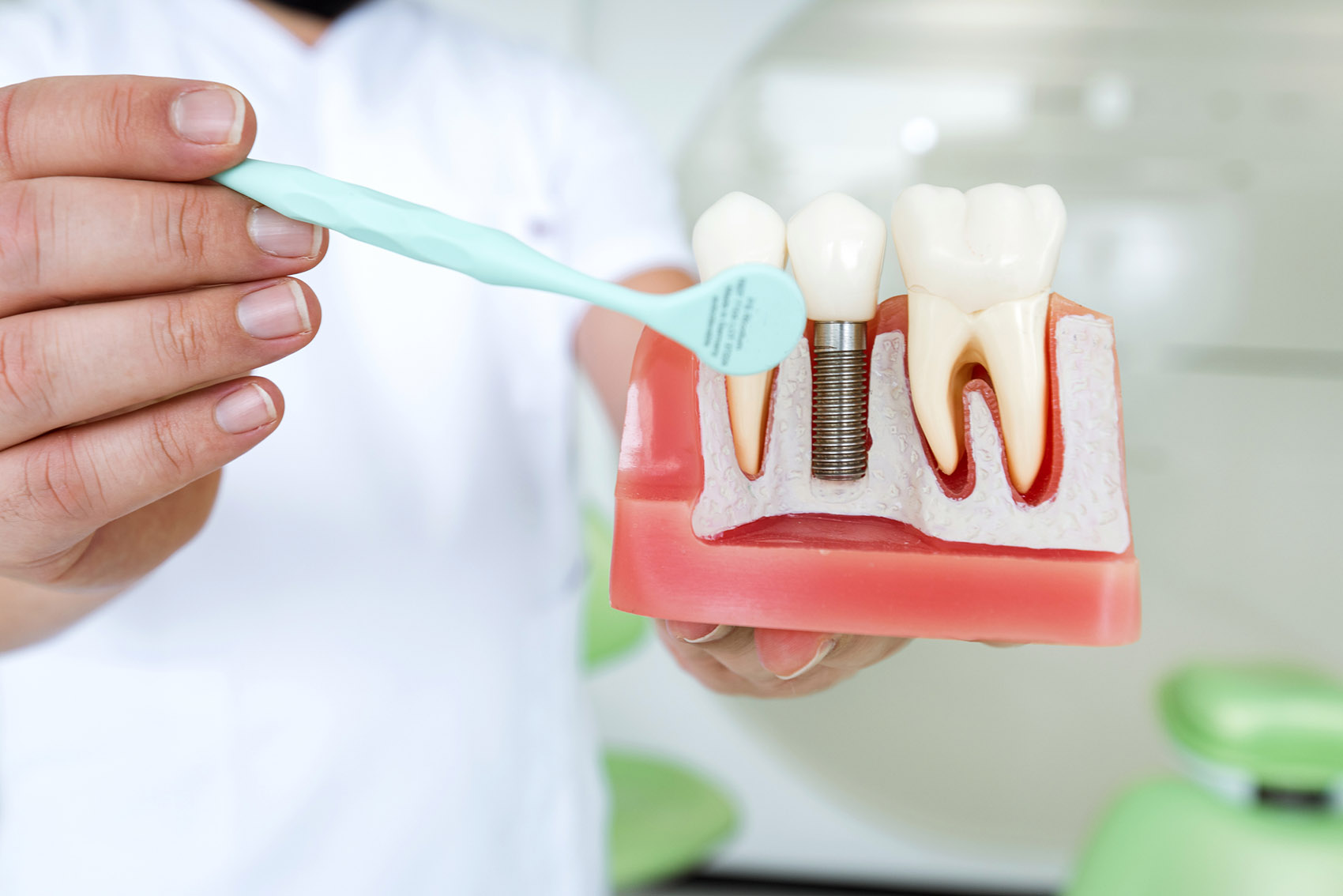 Impianti dentali mal posizionati: perché succede