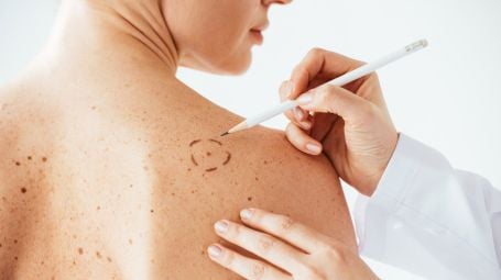 Vaccini contro il melanoma: a che punto siamo