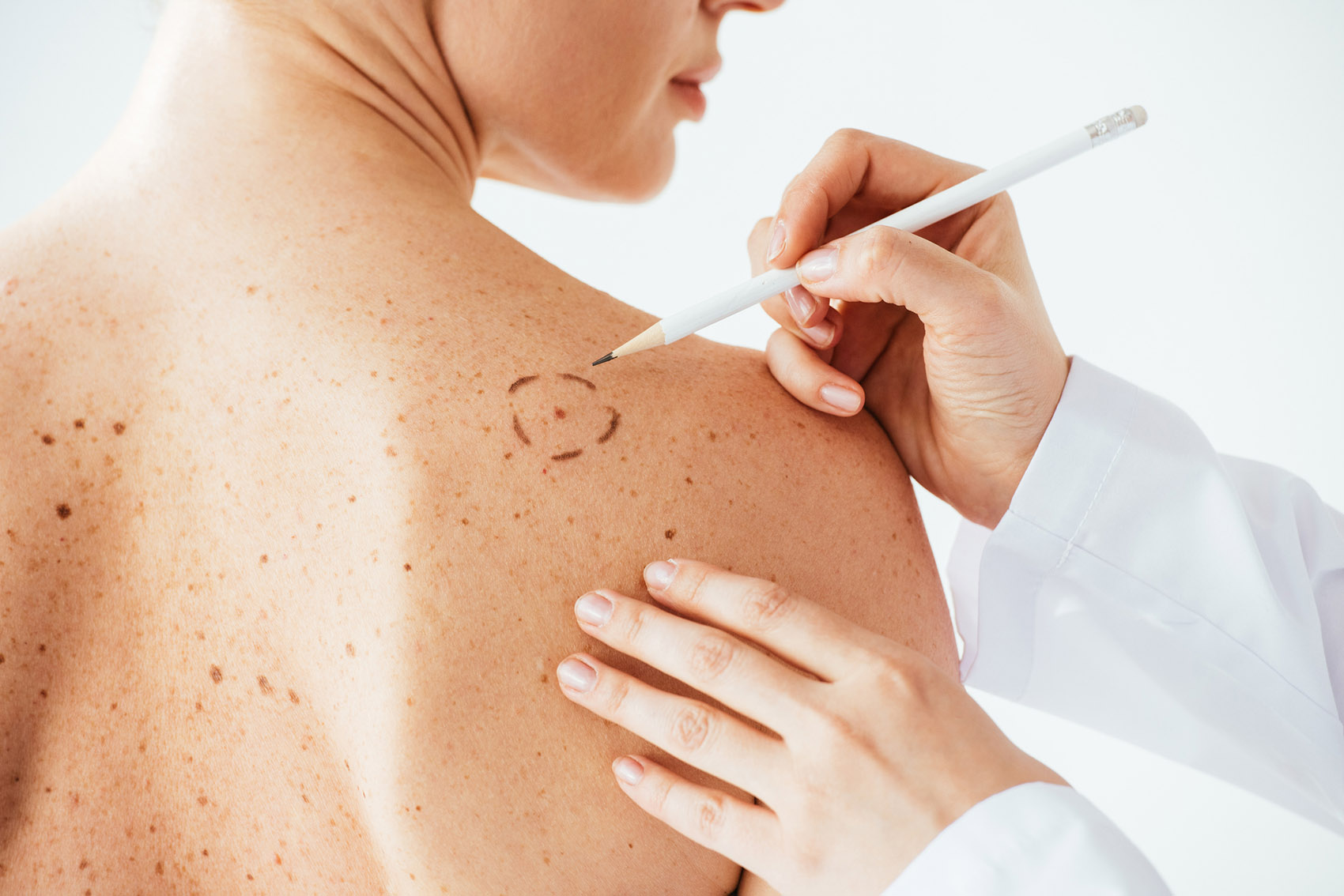 Vaccini contro il melanoma: a che punto siamo Vaccini contro il melanoma: a che punto siamo