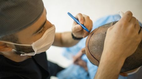 Trapianto di capelli: come funziona e quali sono i risultati