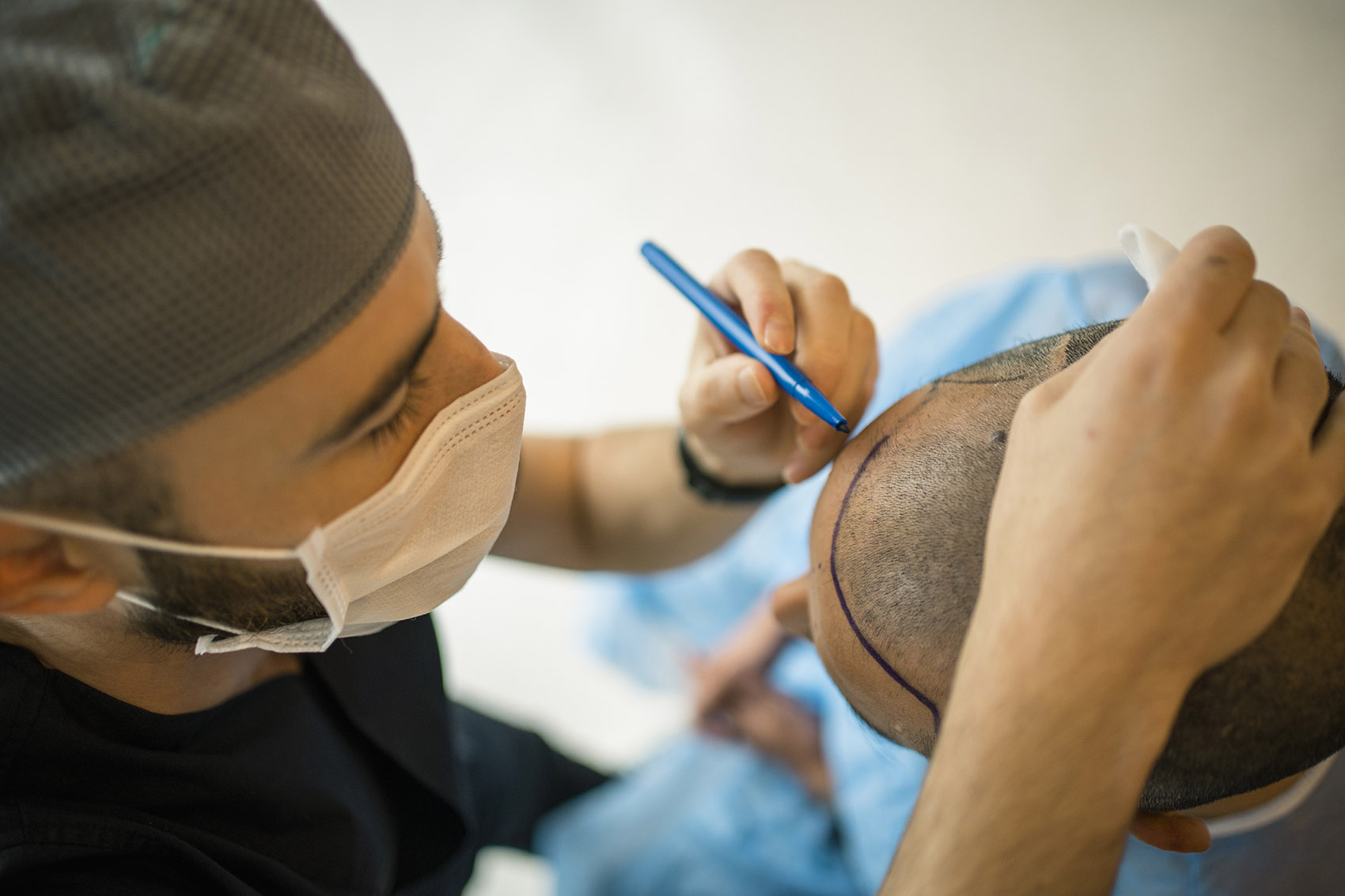 Trapianto di capelli: come funziona e quali sono i risultati
