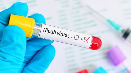 Virus Nipah,  perché preoccupa e cosa sappiamo