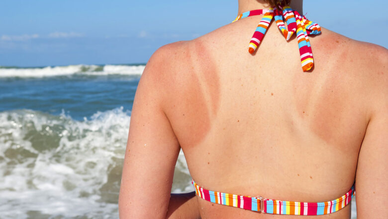 schiena di ragazza scottata dal sole la mare