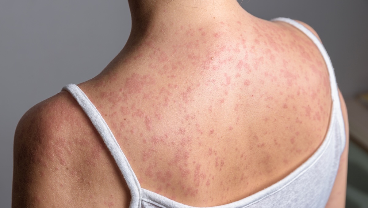 Morbillo, il virus fa di nuovo paura: colpisce anche gli adolescenti e i giovani adulti. Le indicazioni del Ministero Morbillo, il virus fa di nuovo paura: colpisce anche gli adolescenti e i giovani adulti. Le indicazioni del Ministero